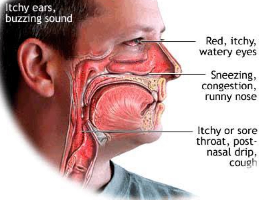 Allergic Rhinitis Symptoms, Causes & Treatment Santripty