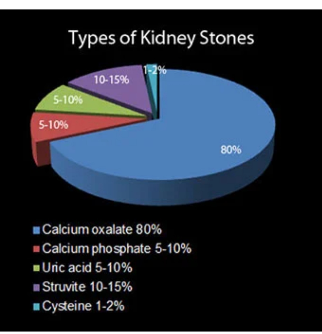 Kidney Stones Symptoms, Types, Causes & Treatment Santripty