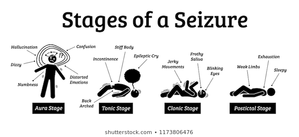 Seizures Symptoms Causes Treatment Santripty