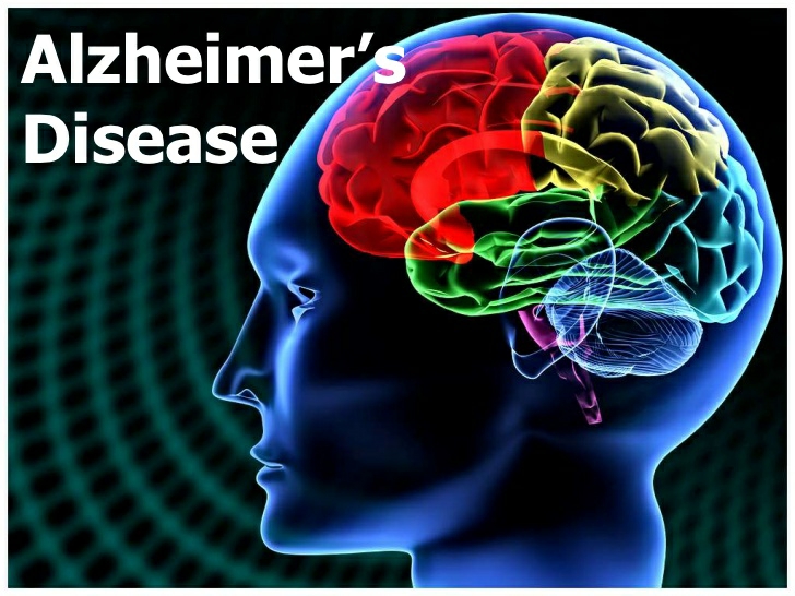 Alzheimer's Disease Symptoms, Causes & Treatment Santripty