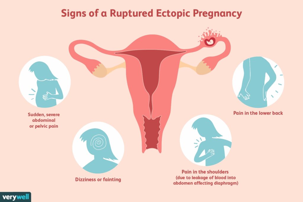 Ectopic Pregnancy Santripty Also Called A Tubal Pregnancy 5818
