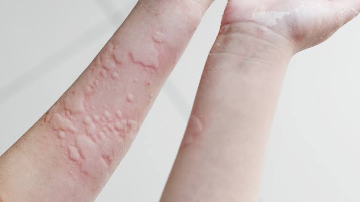 Hives Urticaria Symptoms Causes And Treatment Santripty