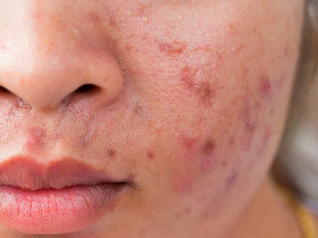 Gandhak rasayan improves acne problem 