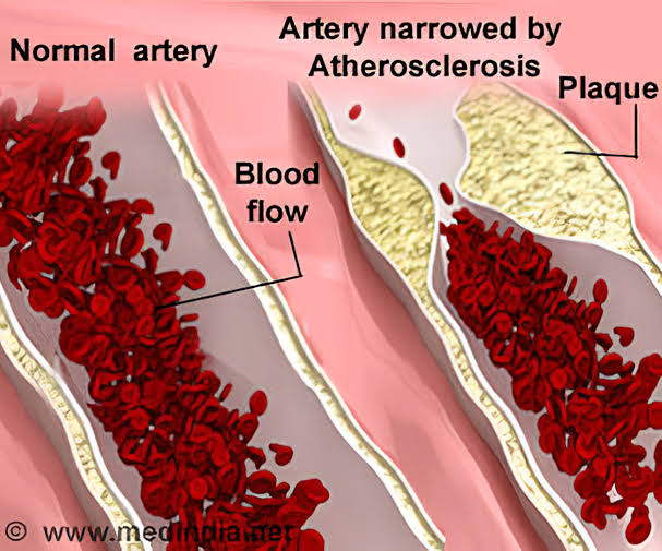 Narrowed artery in atherosclerosis 