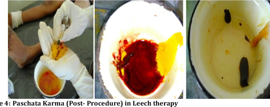 Post therapy treatment of leech 