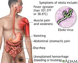 Symptoms of Ebola virus disease (EVD)