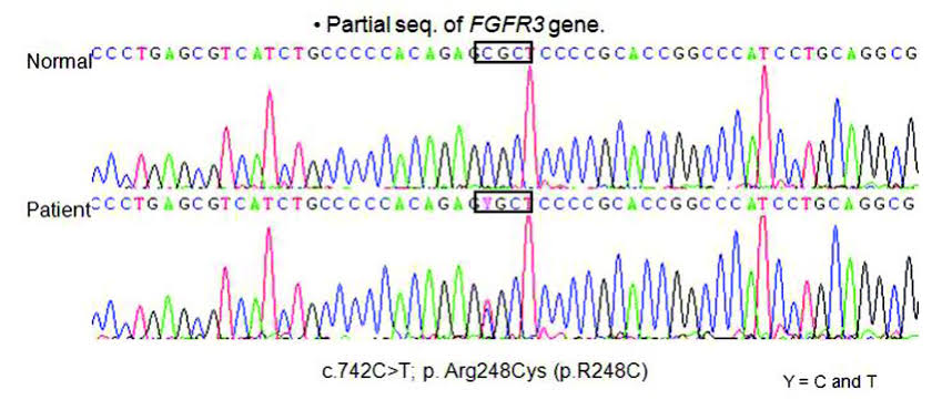 Genetic sequence defect in achondroplasia 