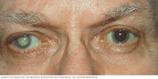 Yashad Bhasma treats eye diseases 