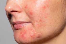 Remove acne toxins 
