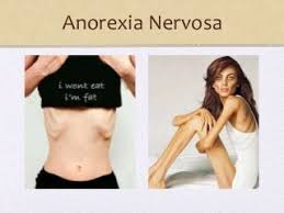 Complications of anorexia nervosa 