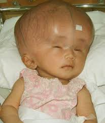 One of the cause of macrocephaly 