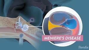 Cause of Meniere’s disease 