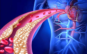Do heart surgery a permanent solution?
No, as cholesterol build happens again