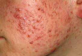 Kumkumadi oil helps treating acne