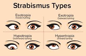 Types of strabismus 