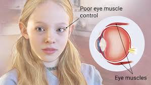 Cause of strabismus 