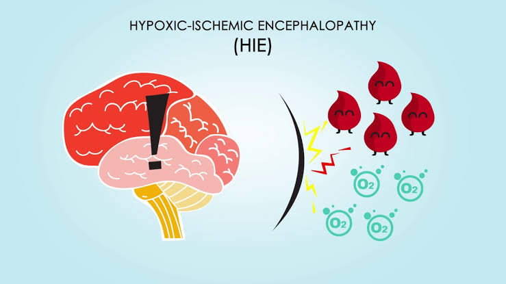 Hypoxic Ischemic Encephalopathy - Signs & Treatment - Santripty