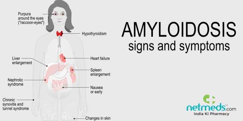 Symptoms of amyloidosis 