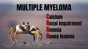 Multiple myeloma causes amyloidosis 