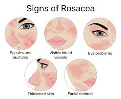 Signs of rosacea 