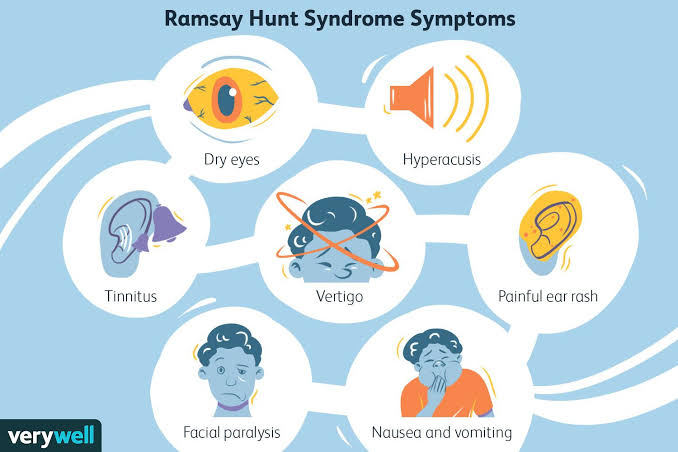Symptoms of Ramsay Hunt Syndrome 