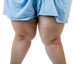 Knock knees with obesity 