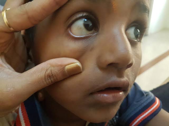 Dusty environment causes conjunctival xerosis 