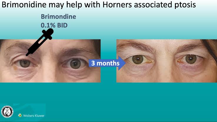 Treatment Horner syndrome 