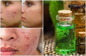 Tea tree oil helps treating acne