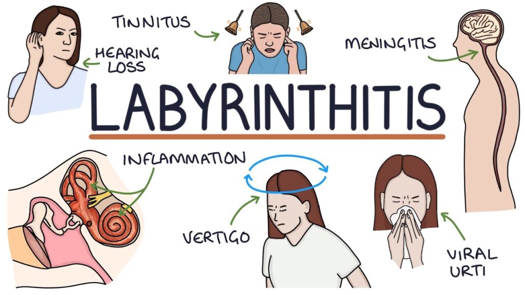 Symptoms of labyrinthitis 
