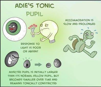 Symptoms of Adie tonic pupil 