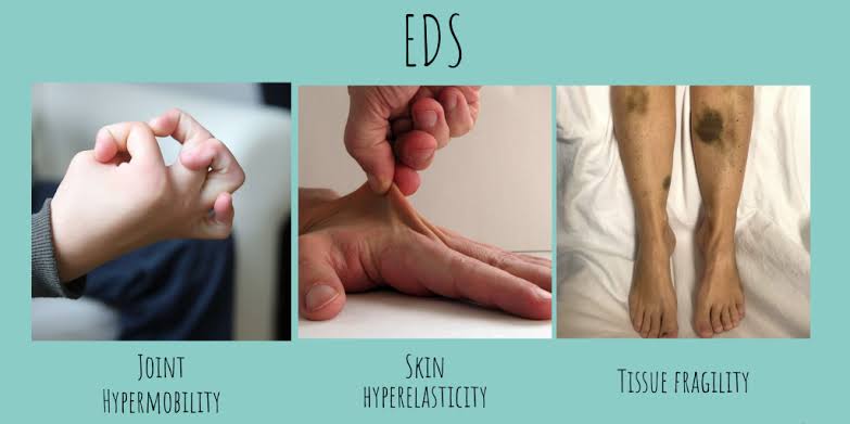 Symptoms of EDS 