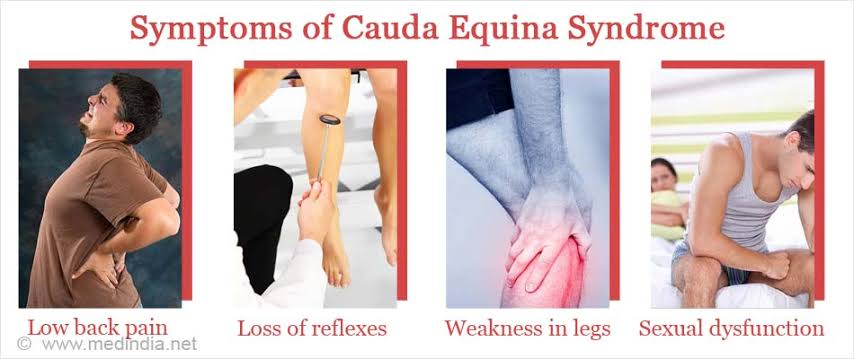 Symptoms of Cauda Equina Syndrome 