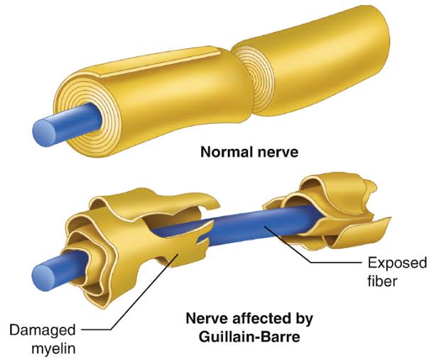 What happens to nerves in gullein Barre syndrome 