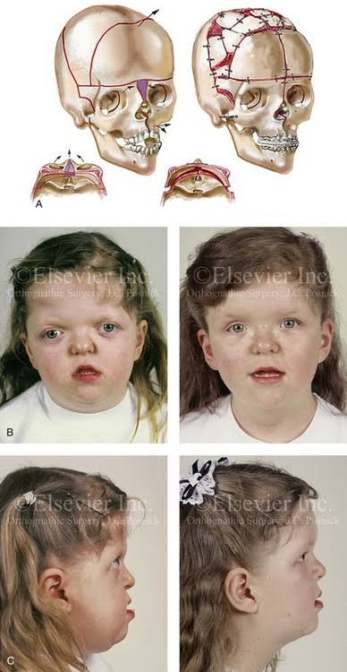 Surgical Treatment of Apert syndrome 