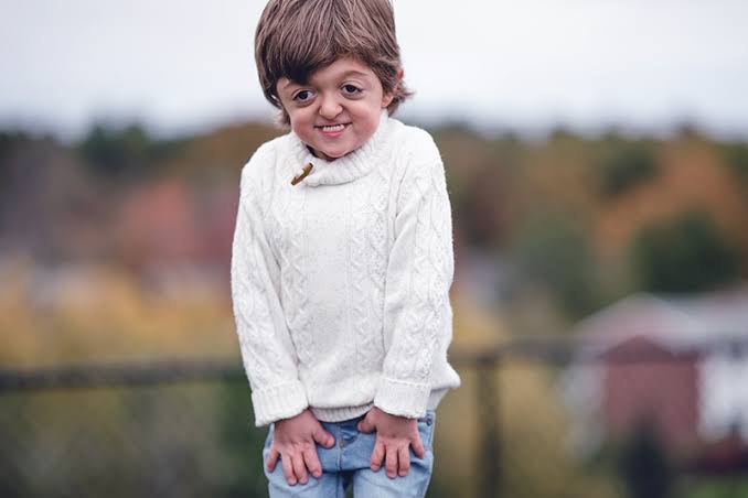 Intellectual disability in Apert syndrome 