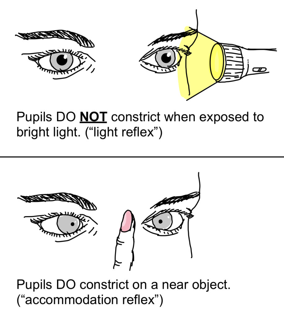Symptoms of Argyll Robertson Pupil 