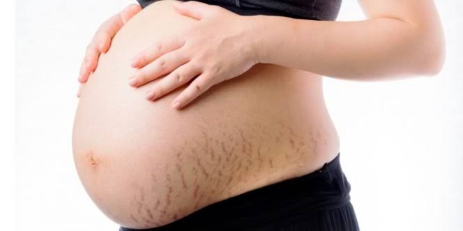 Another significance of desi ghee in pregnancy is helps removing stretch marks 