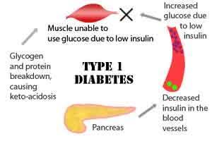 How Type 1 diabetes occurs?