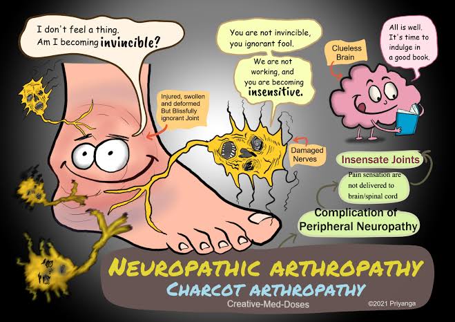 How Charcot's Arthropathy actually feels?