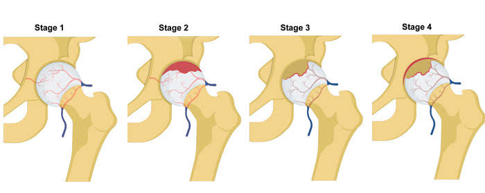 Stages of perthes disease 