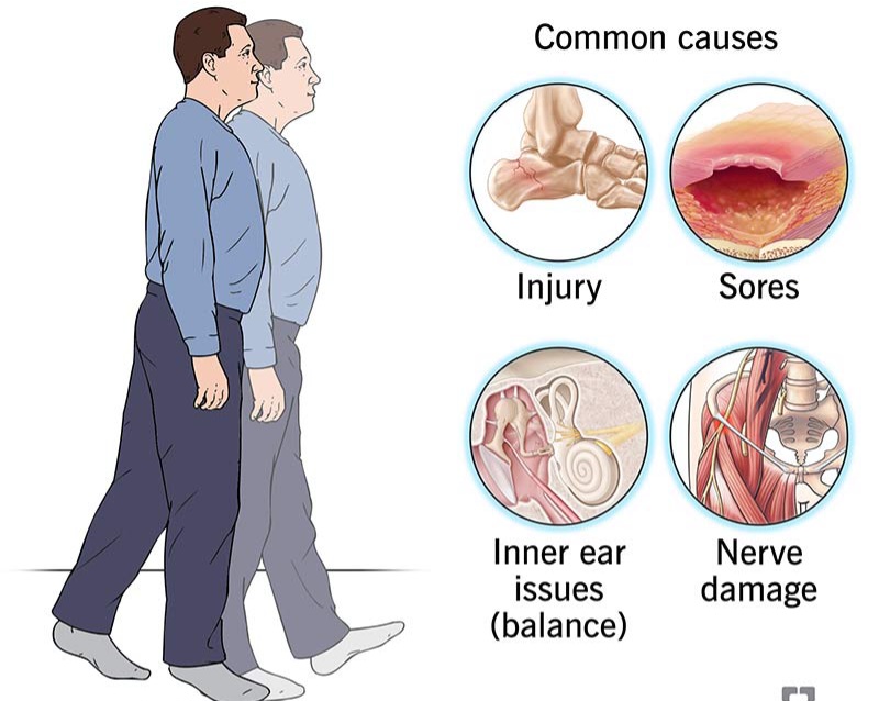 Causes of Gait Abnormalities 