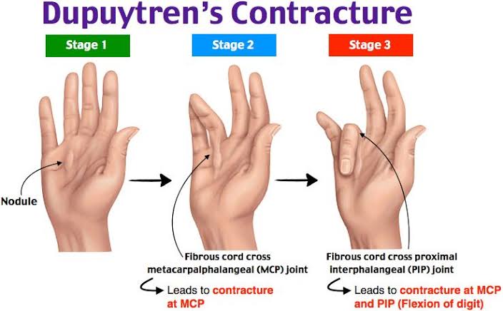 Stages of Dupuytren's contracture 