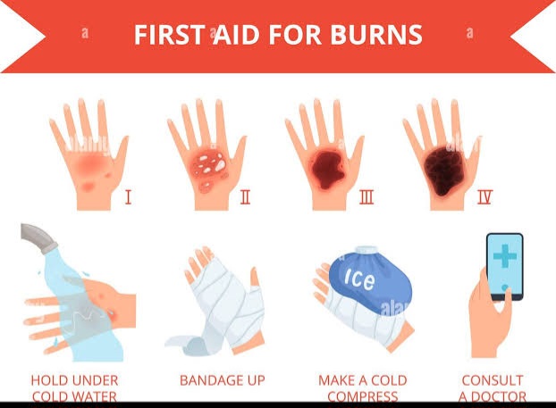 First Aid for different types of burns