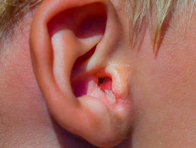 Swimmer's ear infection spread 