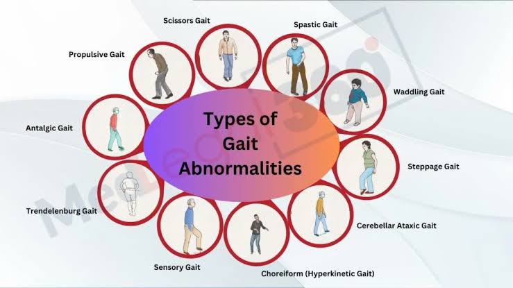 Types of gait abnormalities 