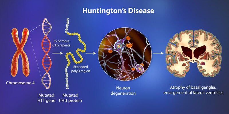 Cause of Huntington's disease ( HD)