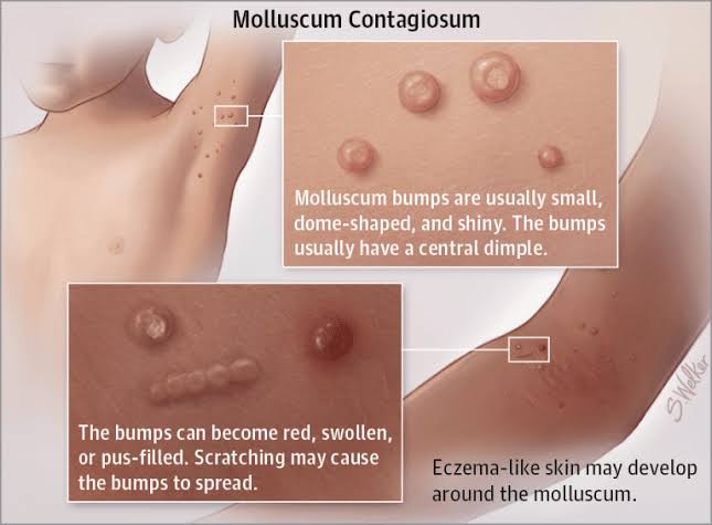 Symptoms of molluscum contagiosum 