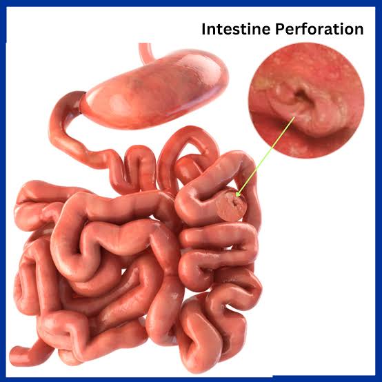 Complication of intestinal Infarction 